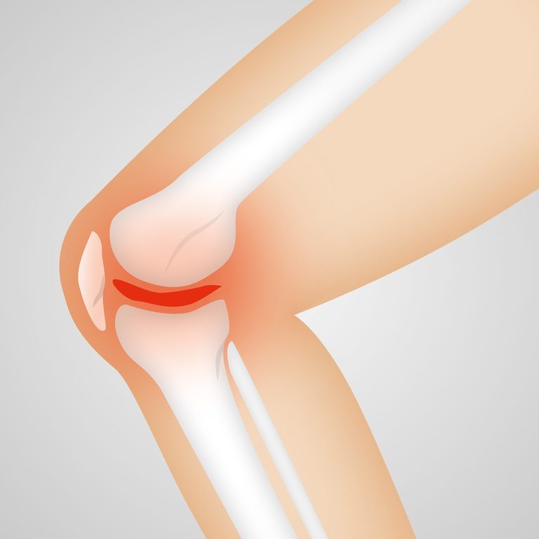 TOTAL KNEE REPLACEMENT: WHAT YOU NEED TO KNOW BEFORE HAVING SURGERY