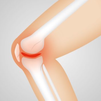 arthrocalman, osteoarthritis, knee-2384254.jpg